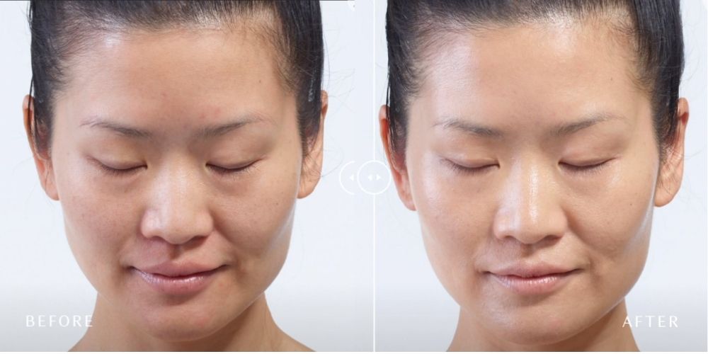 Woman's before and after Diamond Glow treatment at The Radiance MD in Orange, CT.