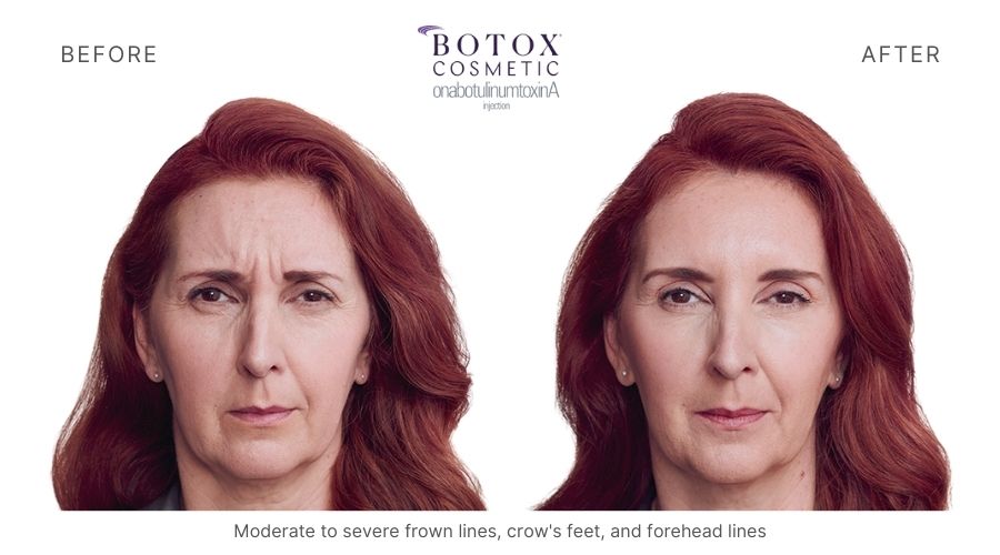 Woman's before and after botox treatment in Orange, CT.