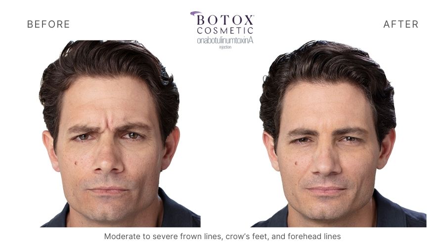 Man's before and after botox treatment in Orange, CT.