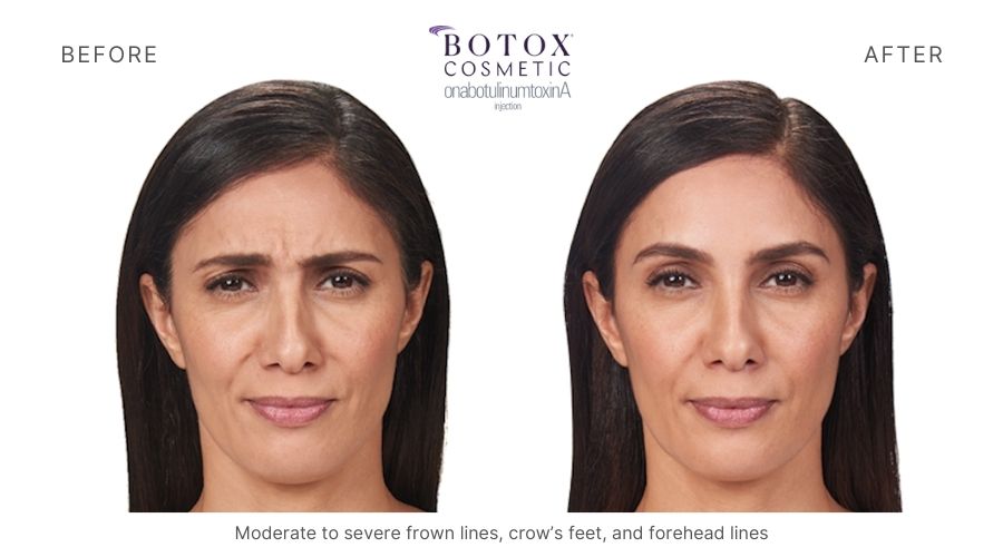 Woman's before and after botox treatment in Orange, CT.