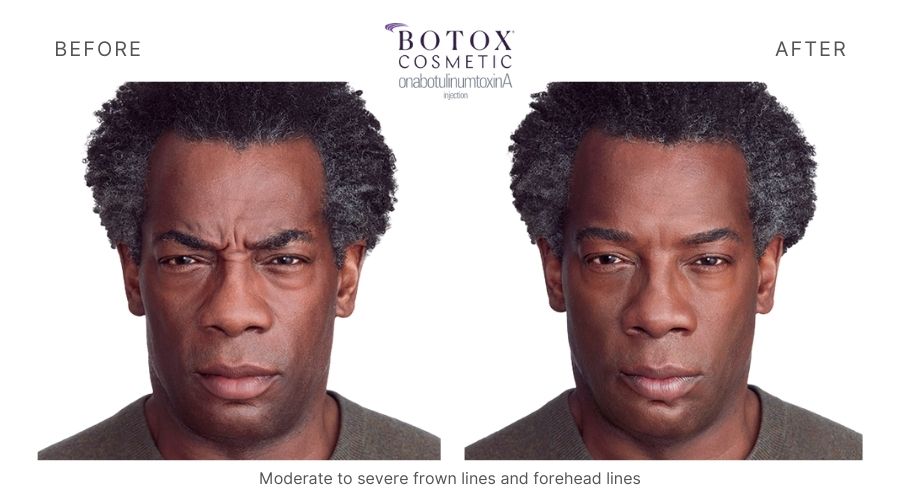 Man's before and after botox treatment in Orange, CT.