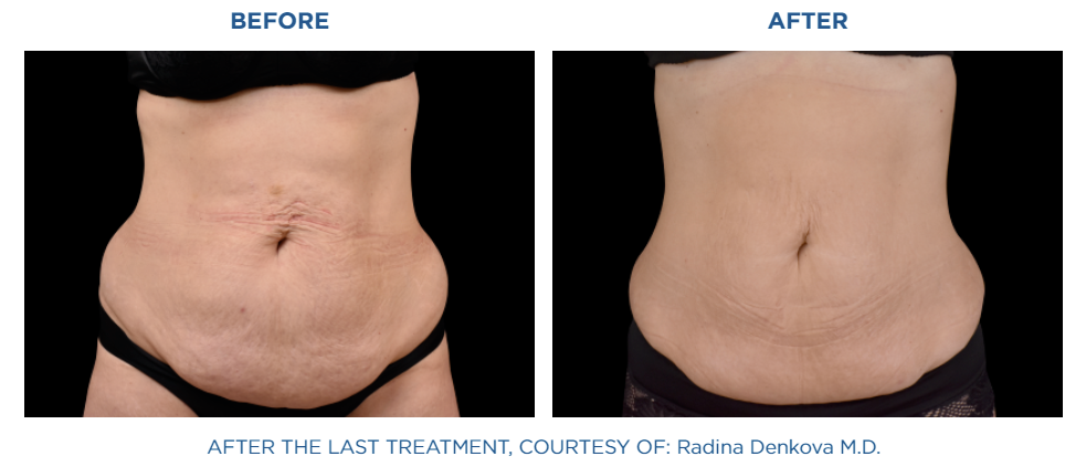 Abdomen before and after emsculpt neo. The Radiance MD, Orange, CT.