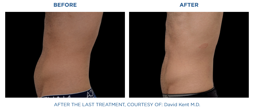 Abdomen before and after emsculpt neo. The Radiance MD.
