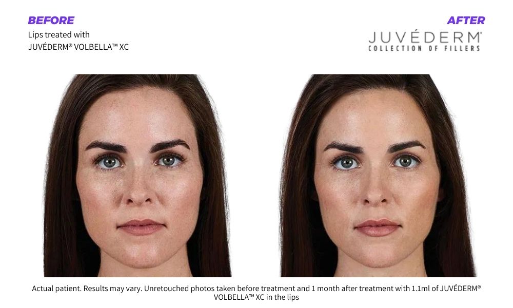 Woman's before and after results from Juvederm fillers done at The Radiance MD in Orange, CT.