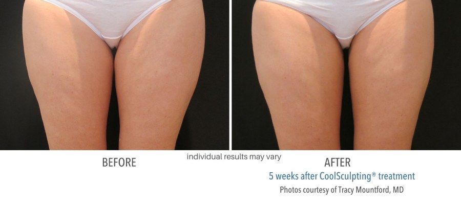 CoolSculpting Elite - Before and After 02