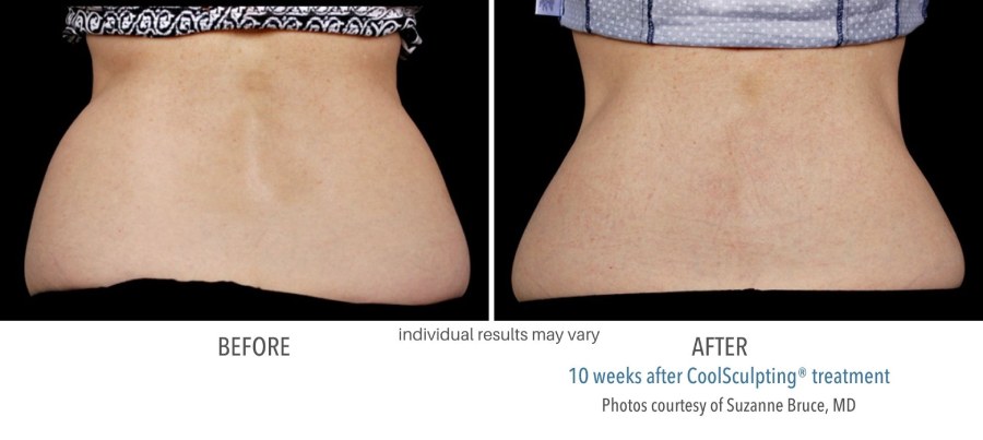 CoolSculpting Elite - Before and After 03
