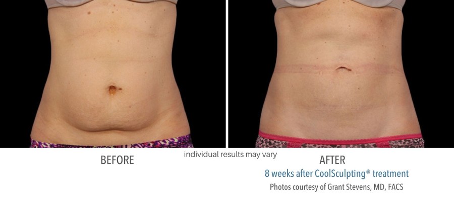 CoolSculpting Elite - Before and After 04
