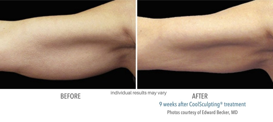 CoolSculpting Elite - Before and After 05