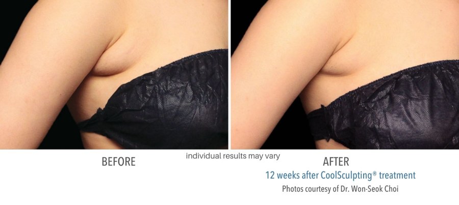 CoolSculpting Elite - Before and After 06