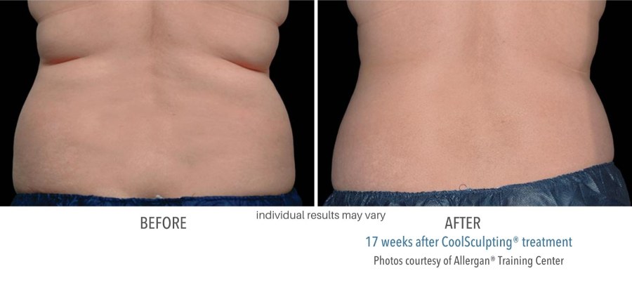 CoolSculpting Elite - Before and After 07