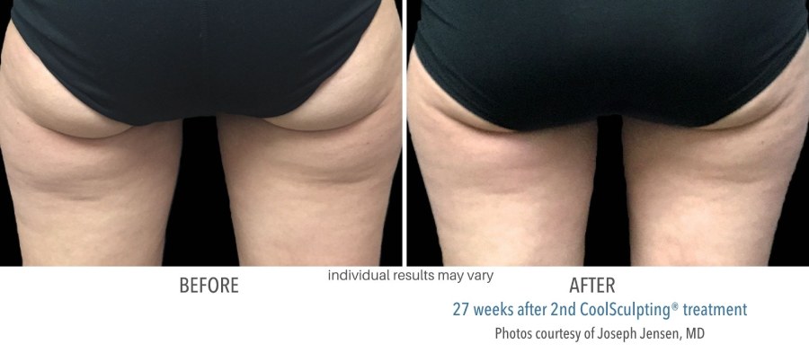 CoolSculpting Elite - Before and After 08